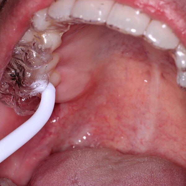 Reliance ReliaPry - Clear Aligner Remover In-Use